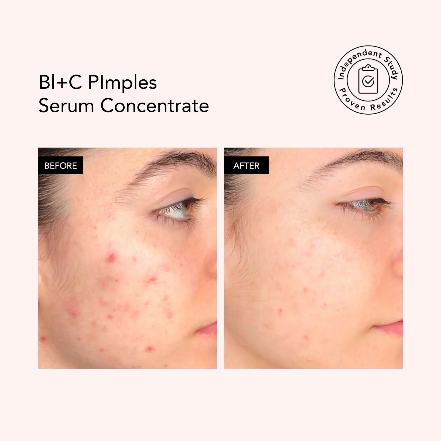 Odacité Serum koncentrat kundër akneve Bl+C 5ml