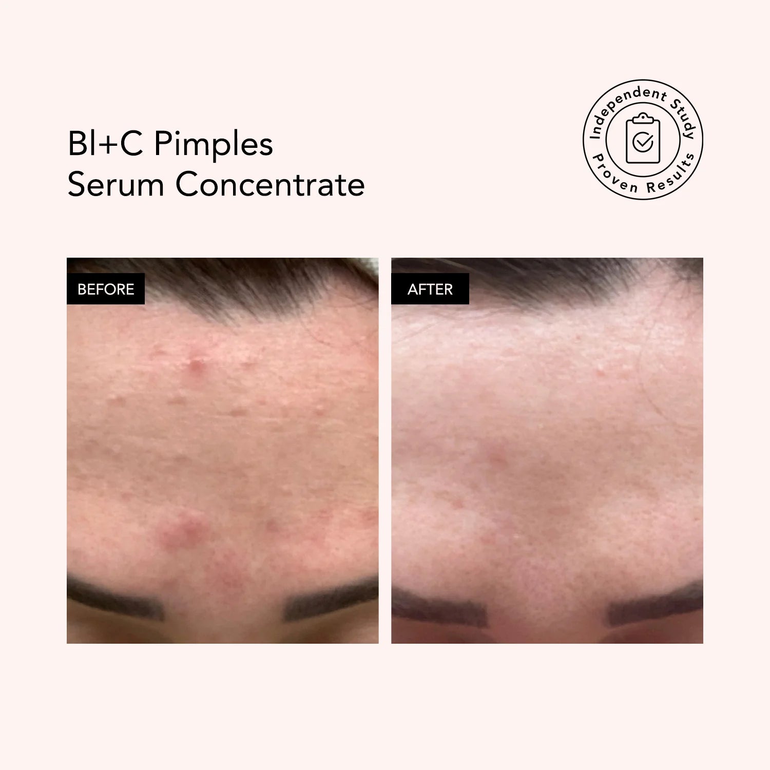 Odacité Serum koncentrat kundër akneve Bl+C 5ml