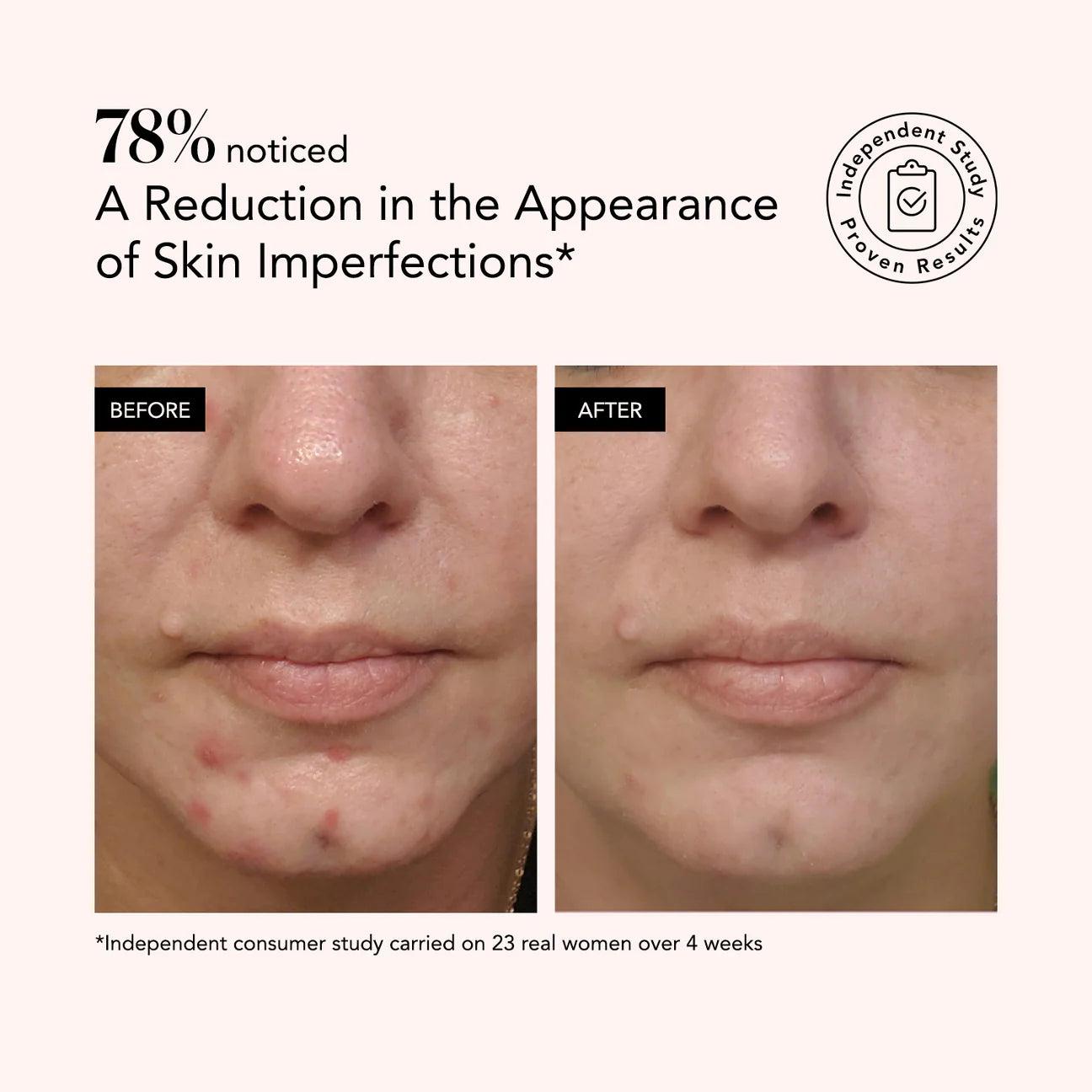 Odacité serum pastrues me Acid Salicilik + Acid Hialuronik 30ml